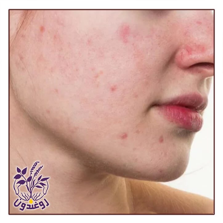 جوش هورمونی