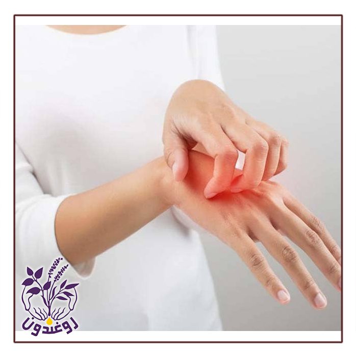 اگزما در فصل بهار
