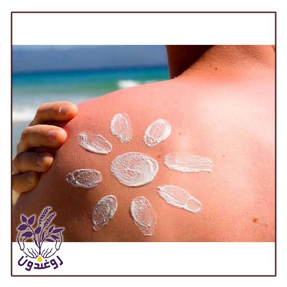 آفتاب سوختگی