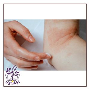 بیماری درماتیت