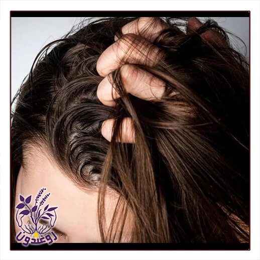 چرب شدن مو