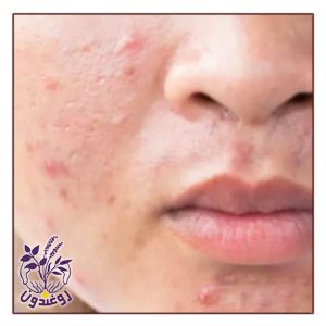 جوش هورمونی