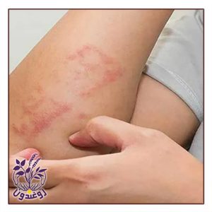 روغن برای اگزما